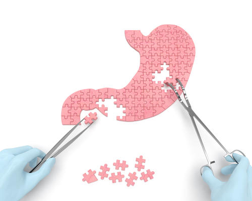 Esta enfermedad sucede cuando el cuerpo se confunde y ataca el intestino. (Foto: Shutterstock)