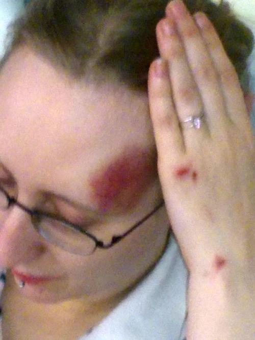 El traumatismo que experimentó Nikki por la caída le dañó el sector del cerebro encargado de los recuerdos. (Foto SWNS)