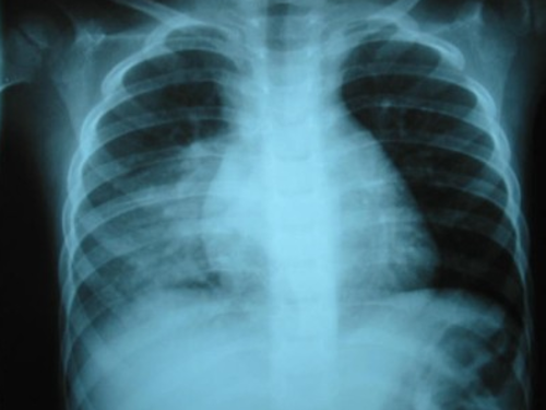 Los síntomas iniciales de la pulmonía son tos persistente y dificultad para respirar.