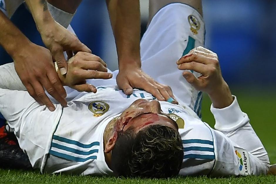 La herida provocada a Cristiano Ronaldo dejó varios puntos de sutura en el rostro del portugués. (Foto: AFP)