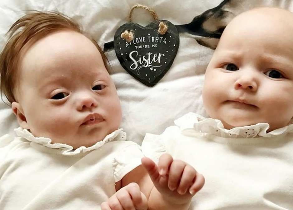 Son mellizas y una tiene síndrome de Down. (Foto: La Nación) 