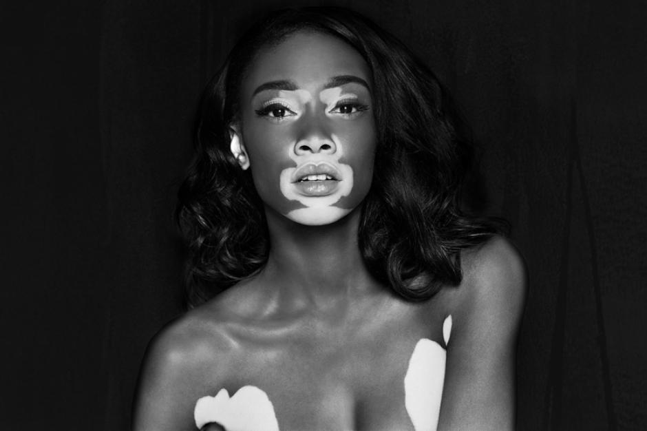 Winnie Harlow es un guapa modelo canadiense de 24 años. (Foto: volnamag.ru)