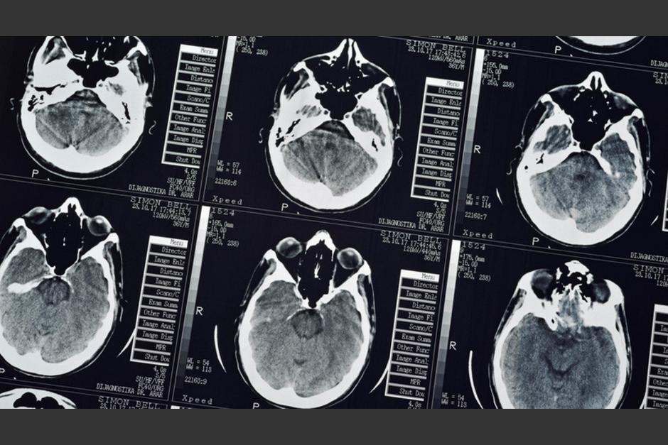 Afirman que los síntomas del alzhéimer pueden estar escondidos por muchos años. (Foto: Simon Belcher)