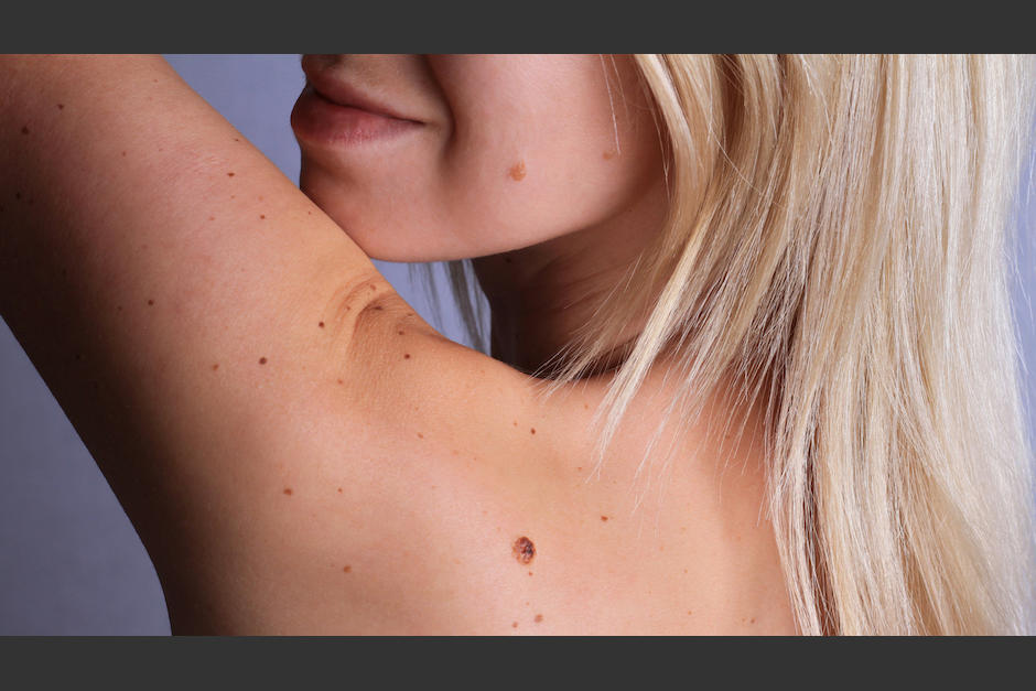 Descubre por qué aparecen y si son peligrosos o no. (Foto: Pixabay) 