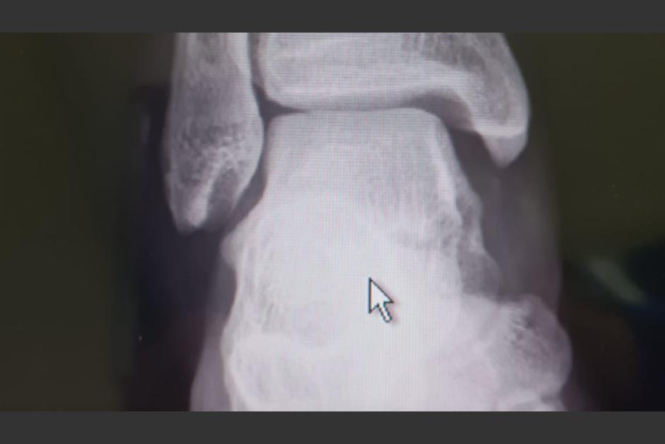 La lesión ocurrió durante el partido entre el América de México y el Olimpia de Honduras. (Foto: Fernando Palomo/ESPN) 