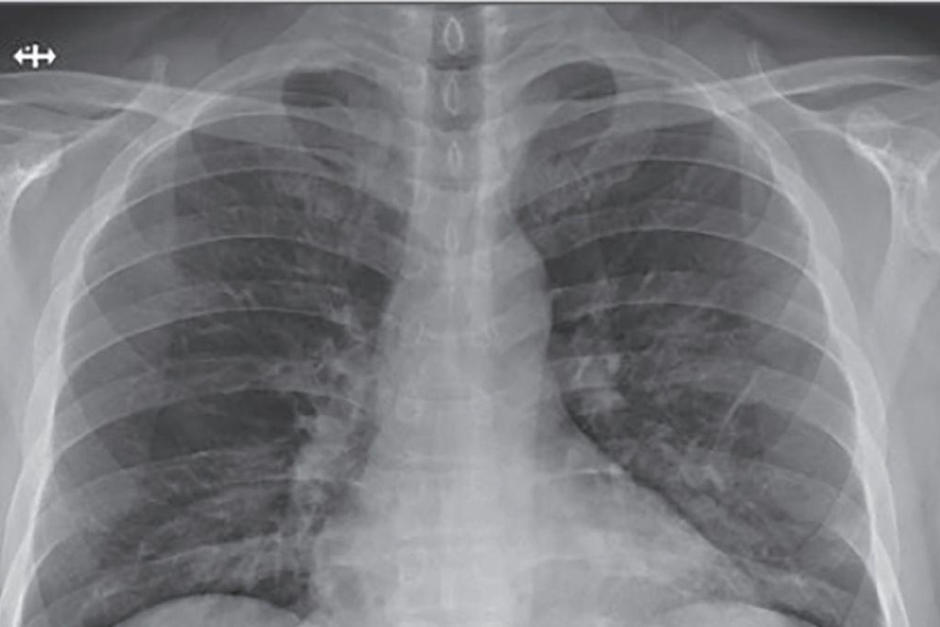 Los pulmones de los pacientes con Covid-19 se dañan más que los de los fumadores. (Foto: Asociación Médica latinoamericana de Rehabilitación)