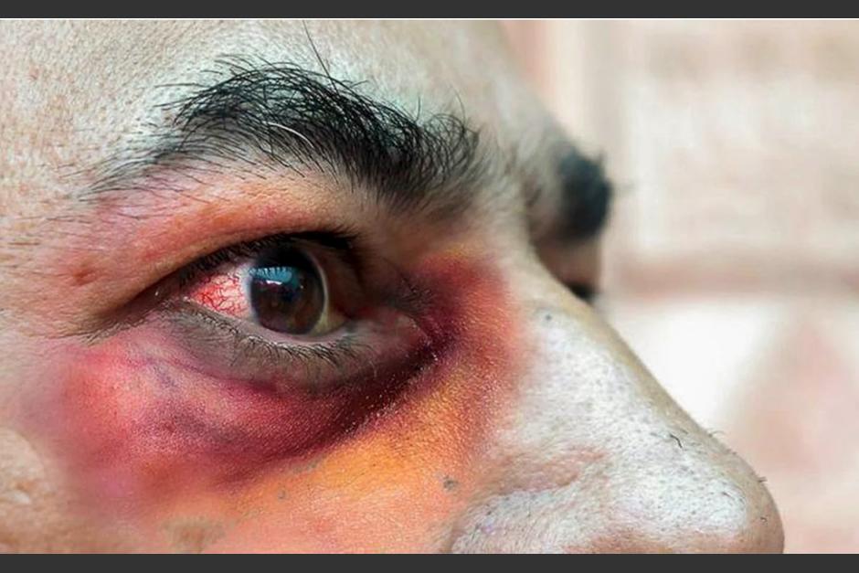 El llamado "hongo negro" es considerada una rara afección que puede llegar a ser letal. (Foto: UNAM, México)