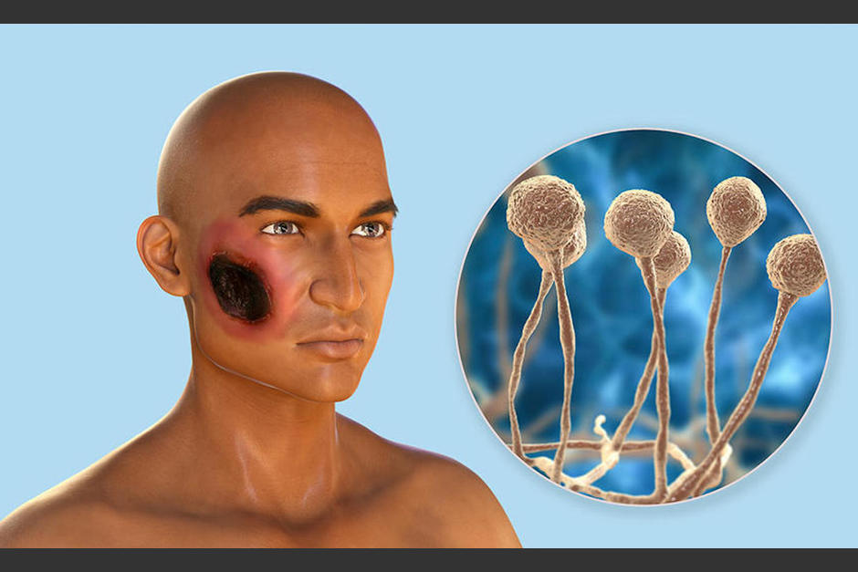 Formas de evitar contagiarse de hongo negro. (Foto: AFP)