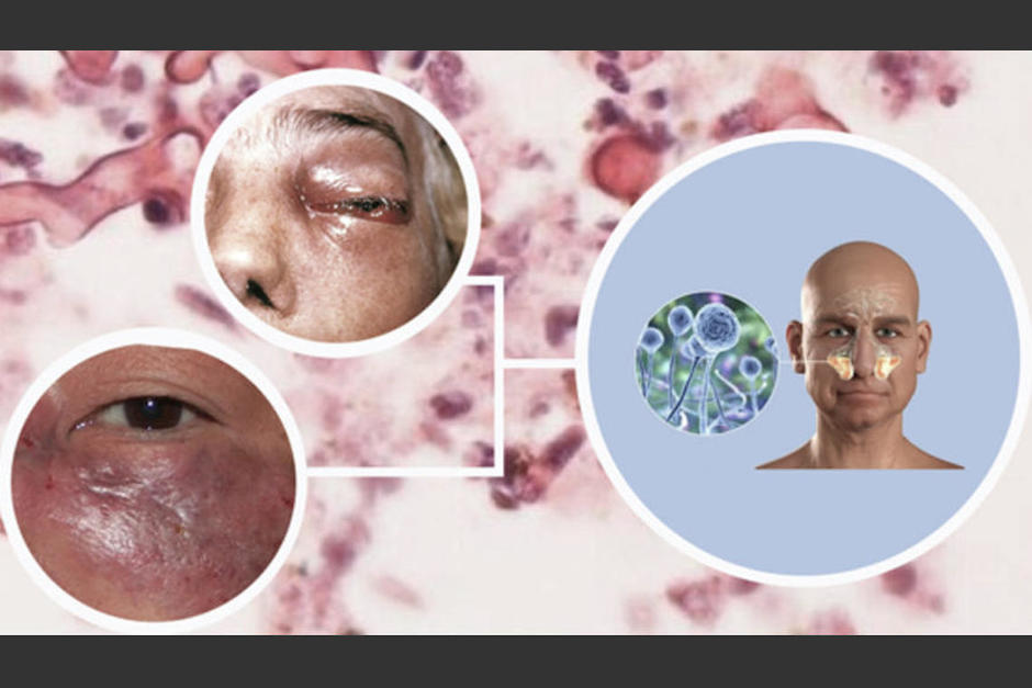 El hongo negro es una infección no contagiosa entre humanos y animales. (Foto: blog amiasistencia)