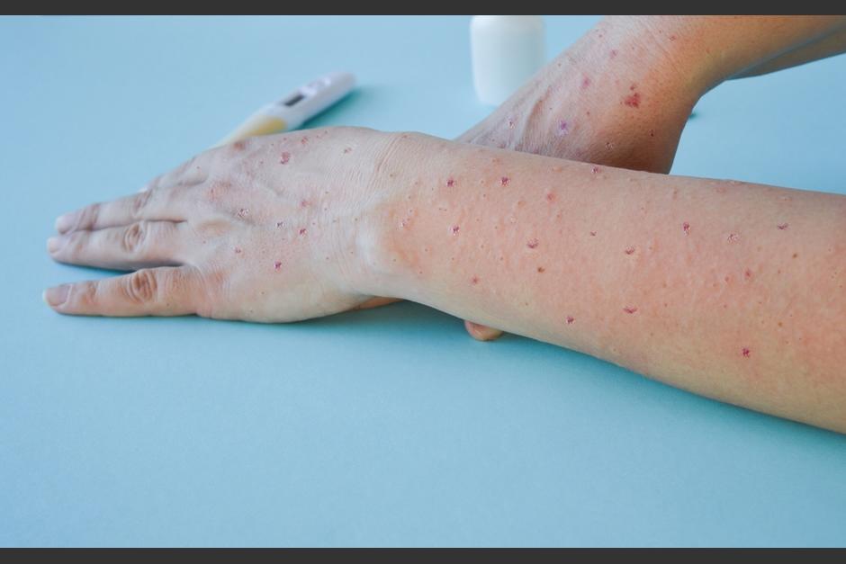 Salud brinda más detalles sobre los dos pacientes contagiados con la viruela del mono. (Foto ilustrativa: Shutterstock)