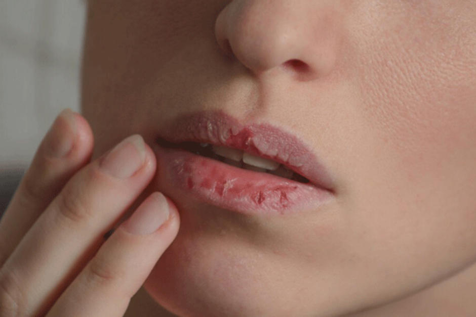 La boca seca podría ser un síntoma de otras enfermedades a las que se le debe prestar atención. (Foto: Pixabay)