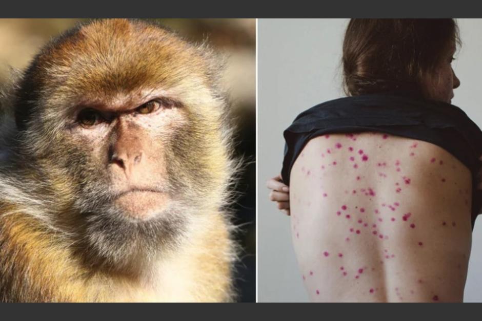 La viruela del mono ha puesto en alerta al mundo desde su aparición. (Foto: Archivo)