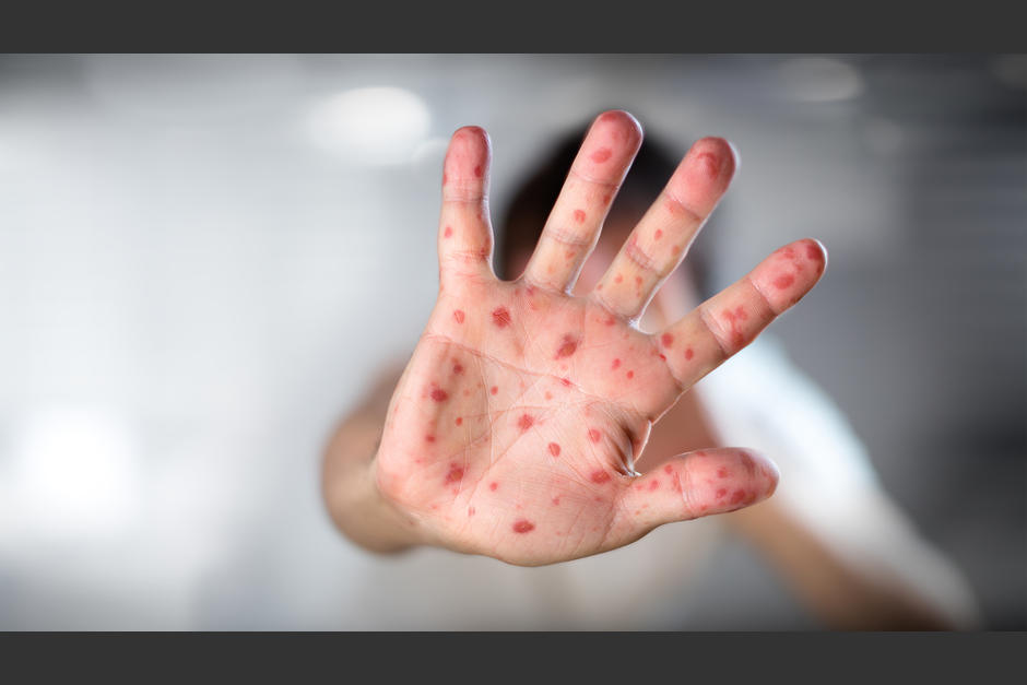 El número de casos confirmados de viruela del mono en el mundo era de 219 el miércoles, sin contar los países donde la enfermedad es endémica. (Foto ilustrativa: www.cronista.com)