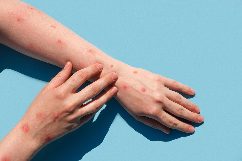 El Ministerio de Salud declaró una epidemia local de sarampión luego de confirmar más de 5,120 casos y cinco fallecimientos. (Foto ilustrativa: Shutterstock)