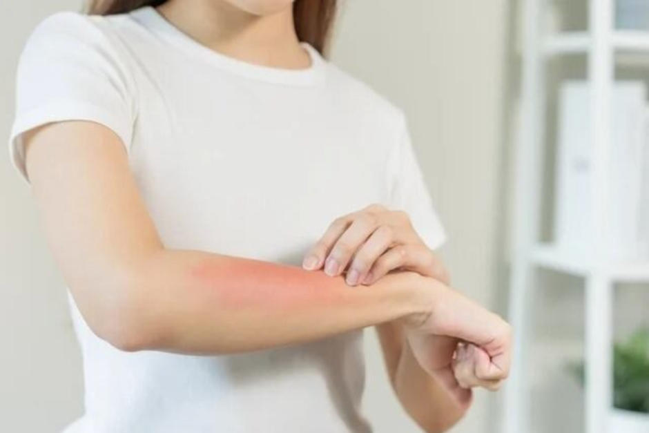 Cuídate del sarampión, toma estas precauciones. (Foto: Pexels)