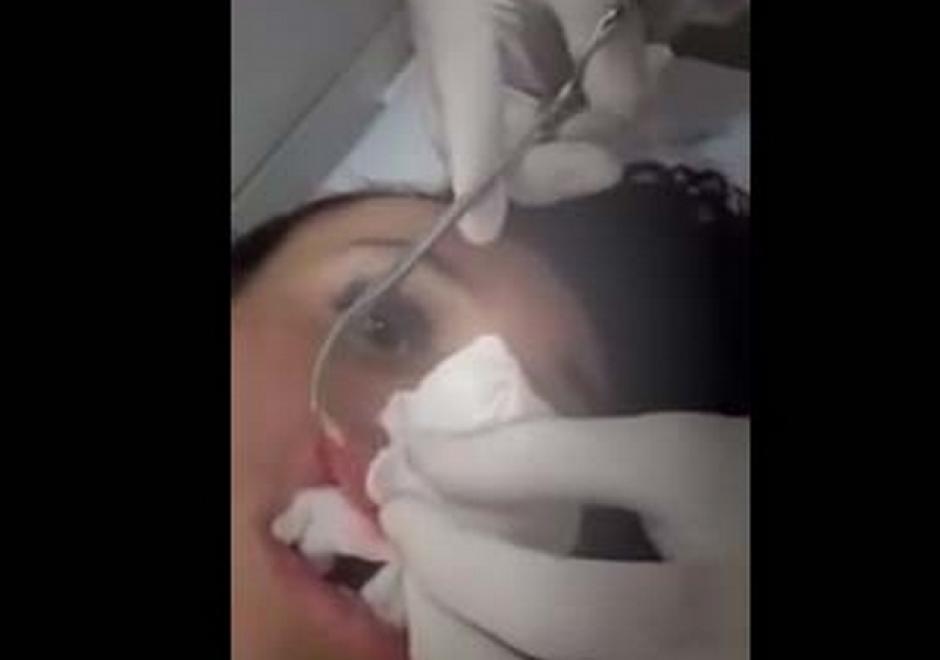 El gusano fue extraído mientras la paciente se encontraba despierta. (Foto: eldiariony.com)