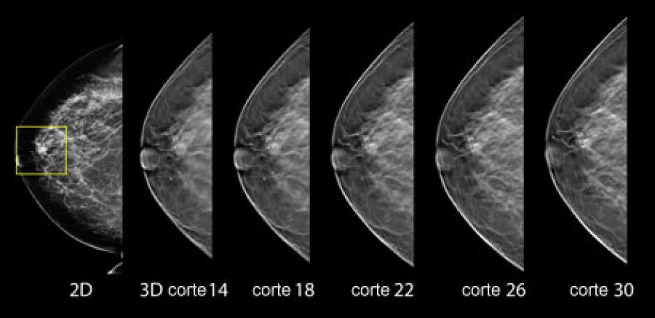 Diferencia entre un diagnóstico 2D y uno en 3D. (Foto: http://www.cancer.gov/)
