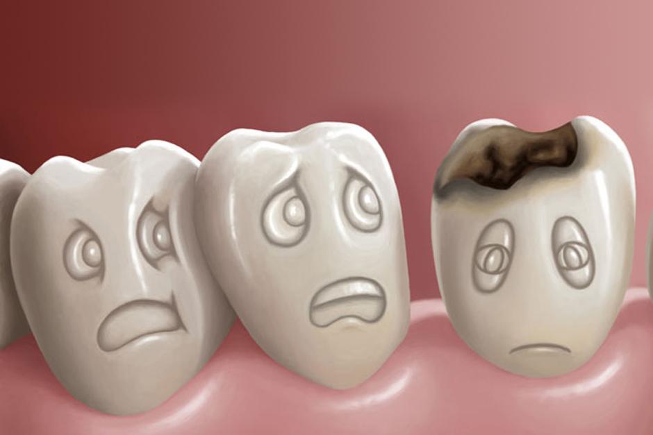 Resultado de la descomposición de los azúcares de los alimentos que ingerimos, genera un ambiente ácido y aumenta el PH del medio bucal. Esto condiciona la presencia de un ambiente cariogénico en la boca.