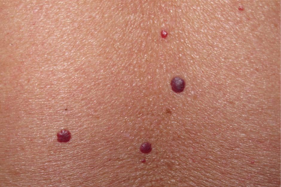 Científicamente, esta patología de puntos rojos sobre la piel se denomina angioma capilar adquirido y tiene un componente familiar muy importante. Los puntos rojos son pequeñas dilataciones capilares debidas a fallos en el sistema vascular. (Foto: EFE)
