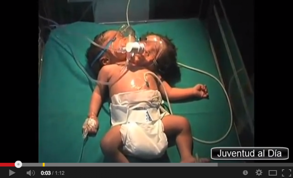 Video muestra a la bebé con dos cabezas, nacida en India. (Foto: YouTube)