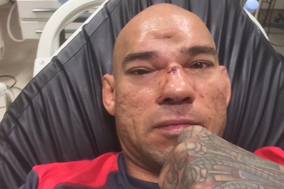 Peleador de MMA sufre hundimiento del cráneo tras rodillazo
