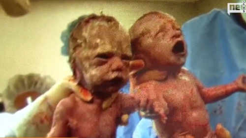 Las gemelas que nacieron tomadas de la mano, pesaron alrededor de 4 libras. (Foto:CNN)  