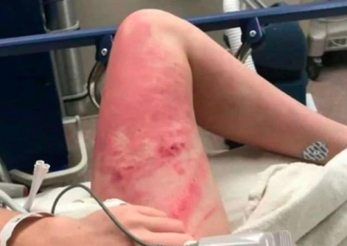 As&iacute; qued&oacute; la pierna de Jordan Holgerson luego de que su amiga la empujara de un puente de 18 metros de altura. (Foto: Info7)