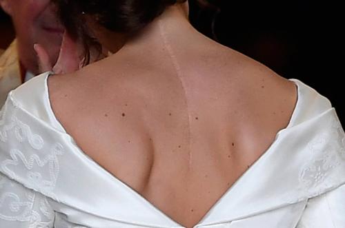 As&iacute; luce la cicatriz de la princesa. (Foto: AFP) 