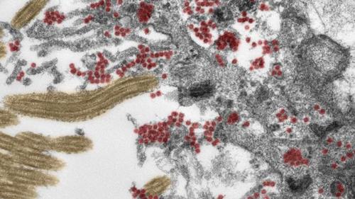 Imagen de microscopio muestra un gran número de partículas de Covid-19 intactas (en rojo) dentro de la mucosa olfativa. (Foto: ABC)