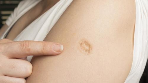 La "toma" es el nombre que se le dio a la cicatriz que le qued&oacute; a las personas que recibieron la vacuna contra la viruela humana. (Foto: Mundo Deportivo)