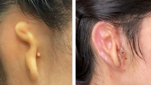 Este es el antes y después de la paciente que recibió el trasplante de oreja, en la segunda fotografía se observa a la paciente 30 días después de la cirugía. (Foto: Arturo Bonilla/Microtia-Congenital Ear Institute)