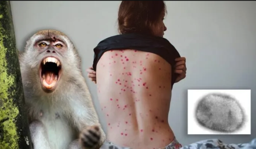 Hay una infección confirmada en Estados Unidos, en Massachusetts, y otros cuatro casos de personas infectadas con orthopoxvirus - de la misma familia a la que pertenece la viruela del mono. (Foto ilustrativa: diarioprimeralinea.com.ar)
