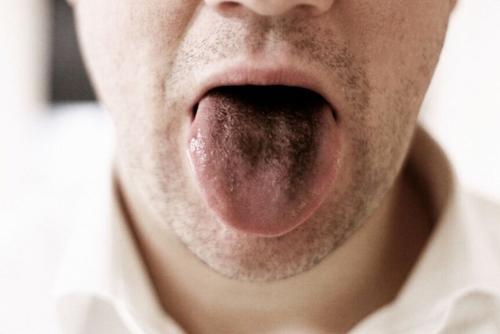 Algunos pacientes han experimentado un padecimiento llamado "Lengua negra". (Foto:  ilustrativa/AM Odontología)
