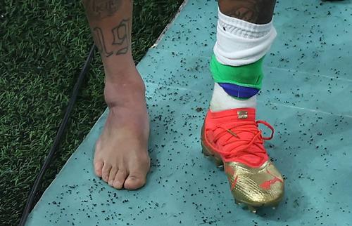 Esta fue la imagen que se captó del tobillo de Neymar tras abandonar el terreno de juego. (Foto: AFP)