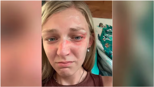 Gabby ten&iacute;a varios moretones en el ojo izquierdo, pero los agentes no tomaron en cuenta estos da&ntilde;os. 