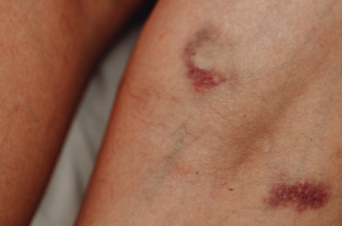 Los moretones "de la nada" pueden indicar una baja en vitaminas. (Foto: ConsejosYTrucos)