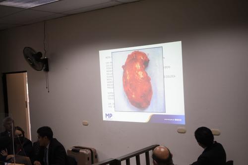 Seg&uacute;n la acusaci&oacute;n del MP, los m&eacute;dicos extrajeron ilegalmente el ri&ntilde;&oacute;n porque no ten&iacute;an el consentimiento de la paciente. (Foto: Wilder L&oacute;pez /Soy502)