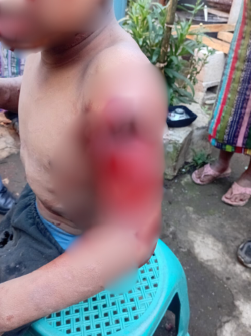 Uno de los hermanos sufri&oacute; una herida abierta en el brazo a parte de las quemaduras. (Foto: Erick Colop/colaborador)