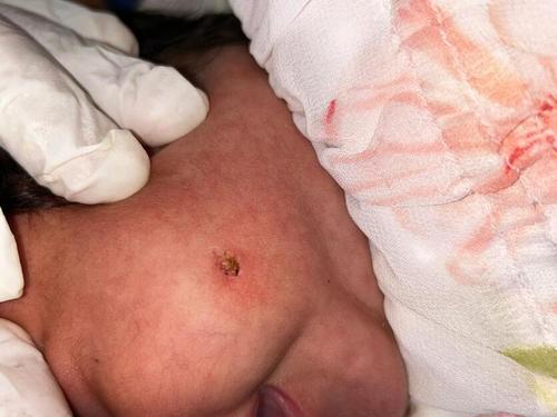 Las verrugas también pueden afectar a niños. (Foto: Manuel Peralta/Colaborador)