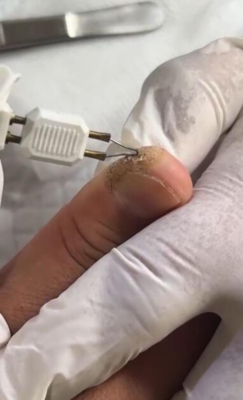 Verrugas plantares: Riesgos, síntomas y tratamientos recomendados. (Foto: Manuel Peralta/Colaborador)