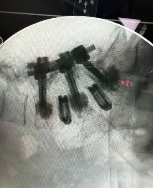 La fotografía de su resonancia magnética con piezas de titanio conmovió a sus fans. (Foto: Instagram)