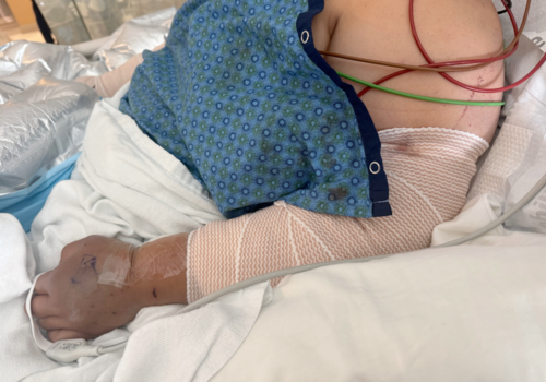 La connacional ha recibido varias cirug&iacute;as, pero podr&iacute;a necesitar m&aacute;s. (Foto: GoFundMe)