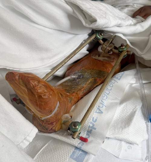 El pie izquierdo de la guatemalteca fue la parte m&aacute;s da&ntilde;ada, por lo que podr&iacute;a perderlo. (Foto: GoFundMe)