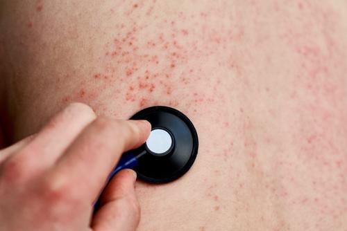 Sarampi&oacute;n, Ministerio de Salud P&uacute;blica y Asistencia Social, contagio, epidemia local, alerta, 03