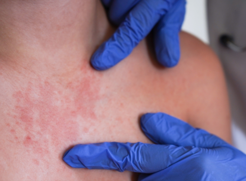 El salpullido es uno de los s&iacute;ntomas del sarampi&oacute;n. (Foto: Shutterstock)