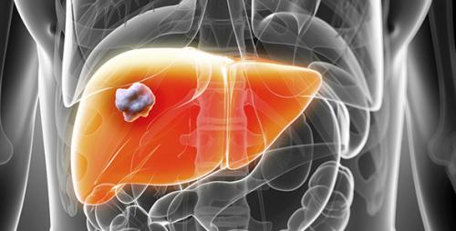 La enzima carbonic anhydrase IX est&aacute; presente en los c&aacute;nceres m&aacute;s agresivos que afectan al h&iacute;gado. (Foto: VidaSana)