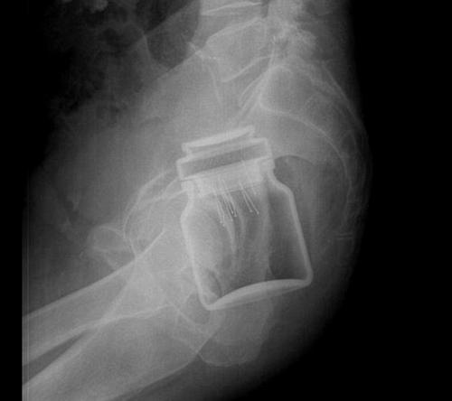 Esta radiograf&iacute;a muestra un bote con alfileres dentro del cuerpo de una persona. 