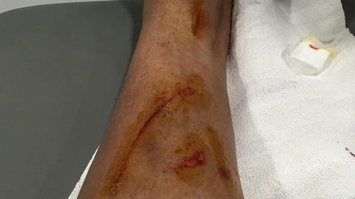 As&iacute; qued&oacute; la pierna de Danilo despu&eacute;s de la fuerte entrada por parte de David Garc&iacute;a. (Foto: Marca)