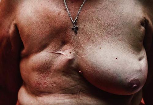 La fotograf&iacute;a de Glorianna Ximendaz muestra el lado oscuro del c&aacute;ncer de mama, el que se esconde en las campa&ntilde;as comerciales. 