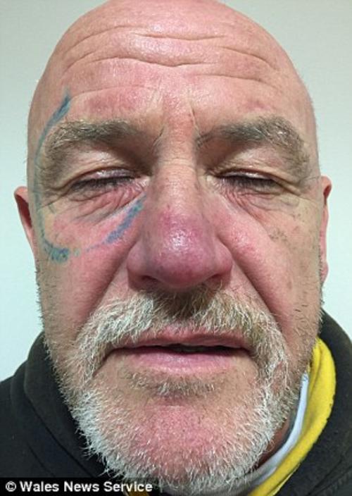 El hombre se ha sometido a una cirug&iacute;a l&aacute;ser para poder deshacerse del tatuaje. (Foto: dailymail.co.uk)